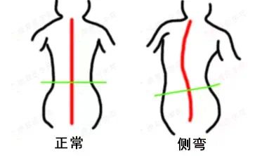 【国家级培训课程】2024年国家体育总局青少年脊柱侧弯体态干预师培训通知(图2)